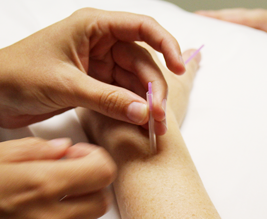 Acupuncture